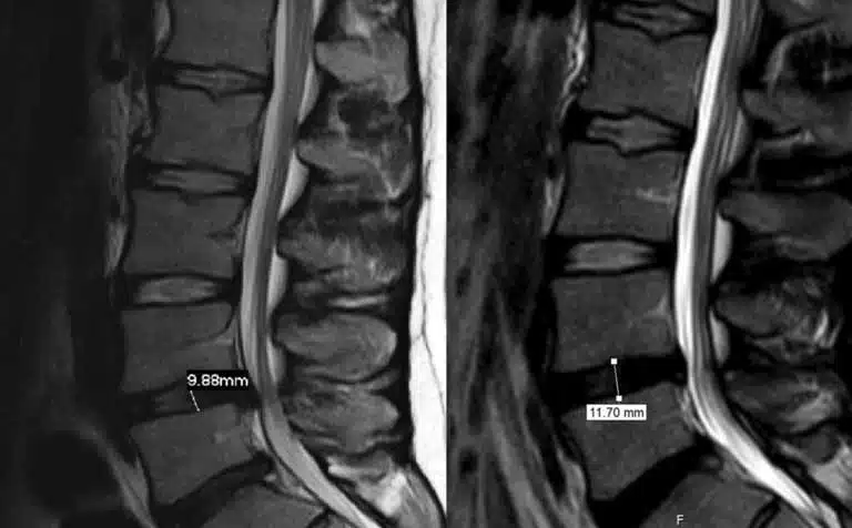 l4-l5 l5-s1 disc bulge treatment in hindi?, l4 l5 and l5 s1 disc bulge exercises in hindi?
