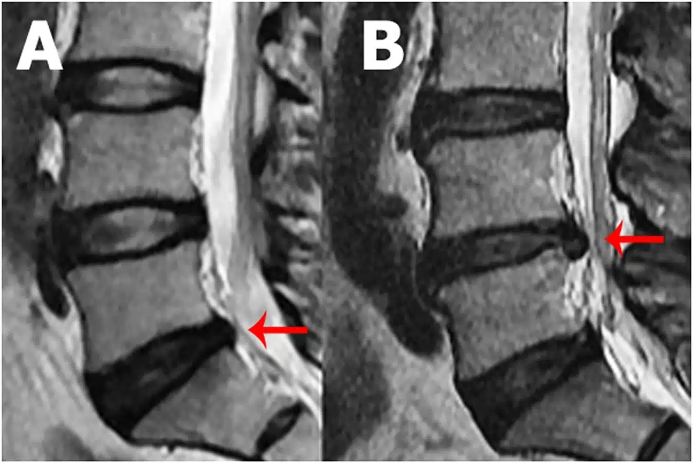 xray compression nerve root disc Bulge herniated l4 l5 s1 disc bulge treatment without surgery in hindi